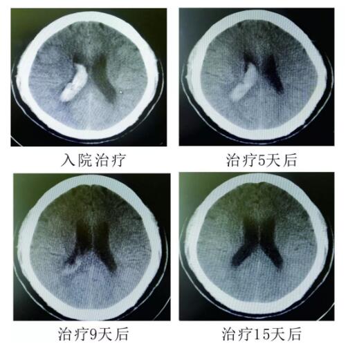 腦出血你不得不引起重視的疾病?。?！