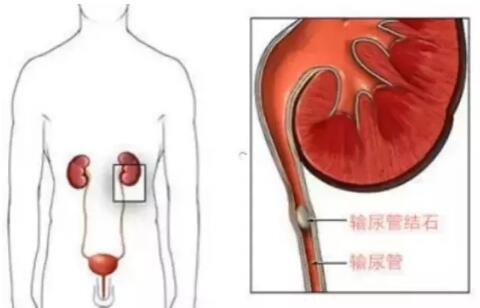 輸尿管結(jié)石，到底能不能保守治療？