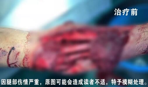 感謝安利醫(yī)院挽救了我的腿，沒有讓我落下殘疾……”
