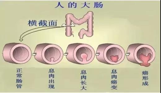 體檢發(fā)現(xiàn)腸息肉會癌變嗎？